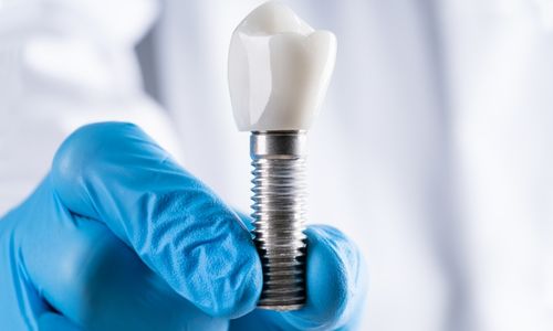 Dental Implant