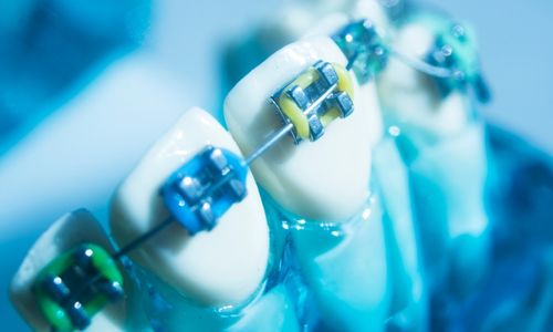 Orthodontics - Braces