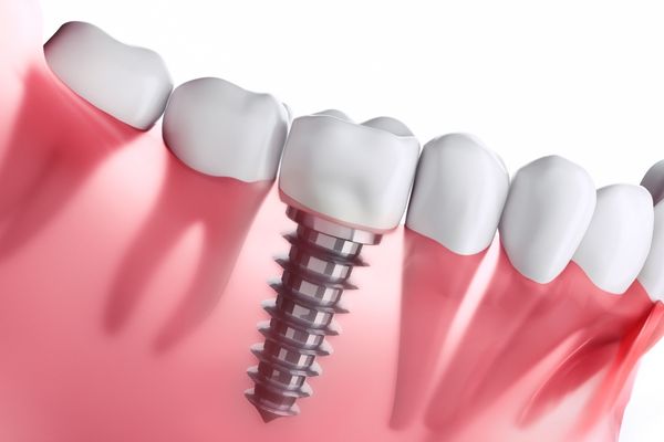Beylikdüzü İmplant - Implant nasıl yapılır? Beylikdüzü İmplant