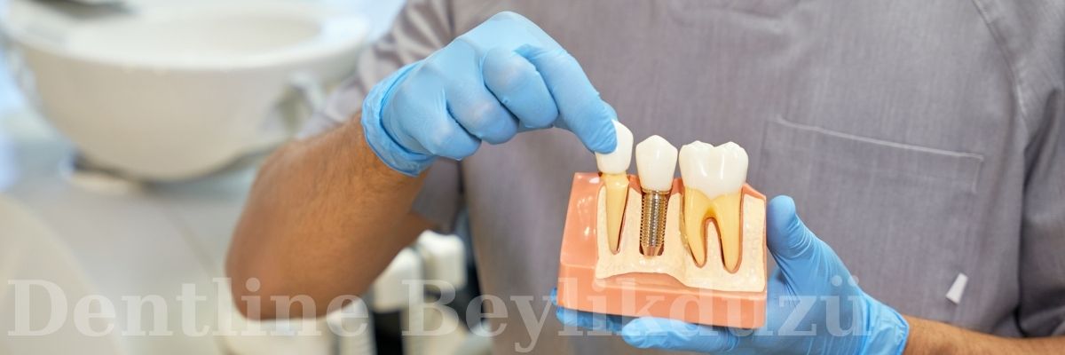 Beylikdüzü İmplant Beylikdüzü İmplant