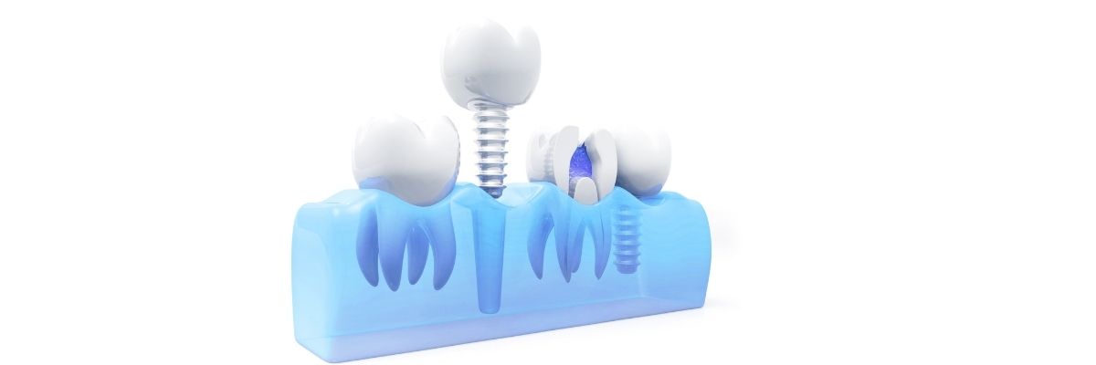 Dental İmplant Nedir?